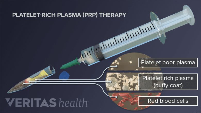 Medicinsk illustration av PRP-behandling med spruta och blodkomponenter.